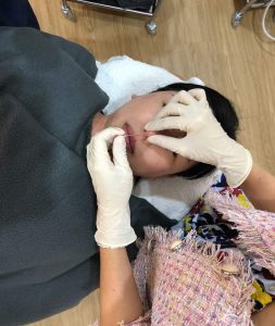 nose threadlift